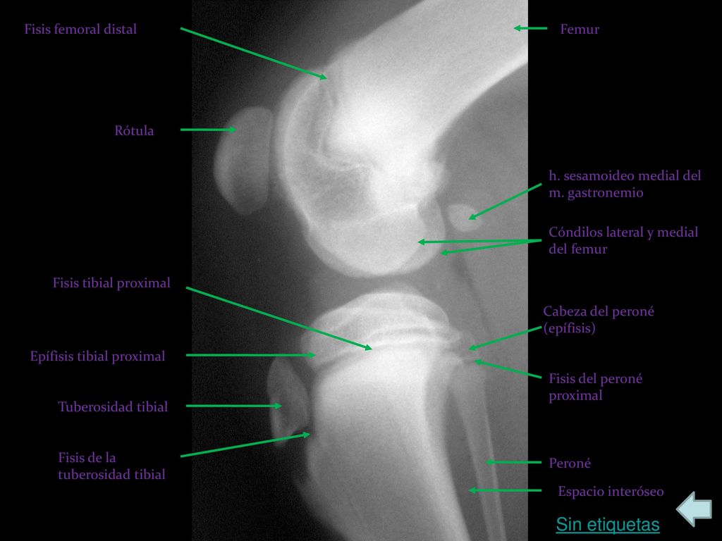 Sin etiquetas Fisis femoral distal Femur Rótula