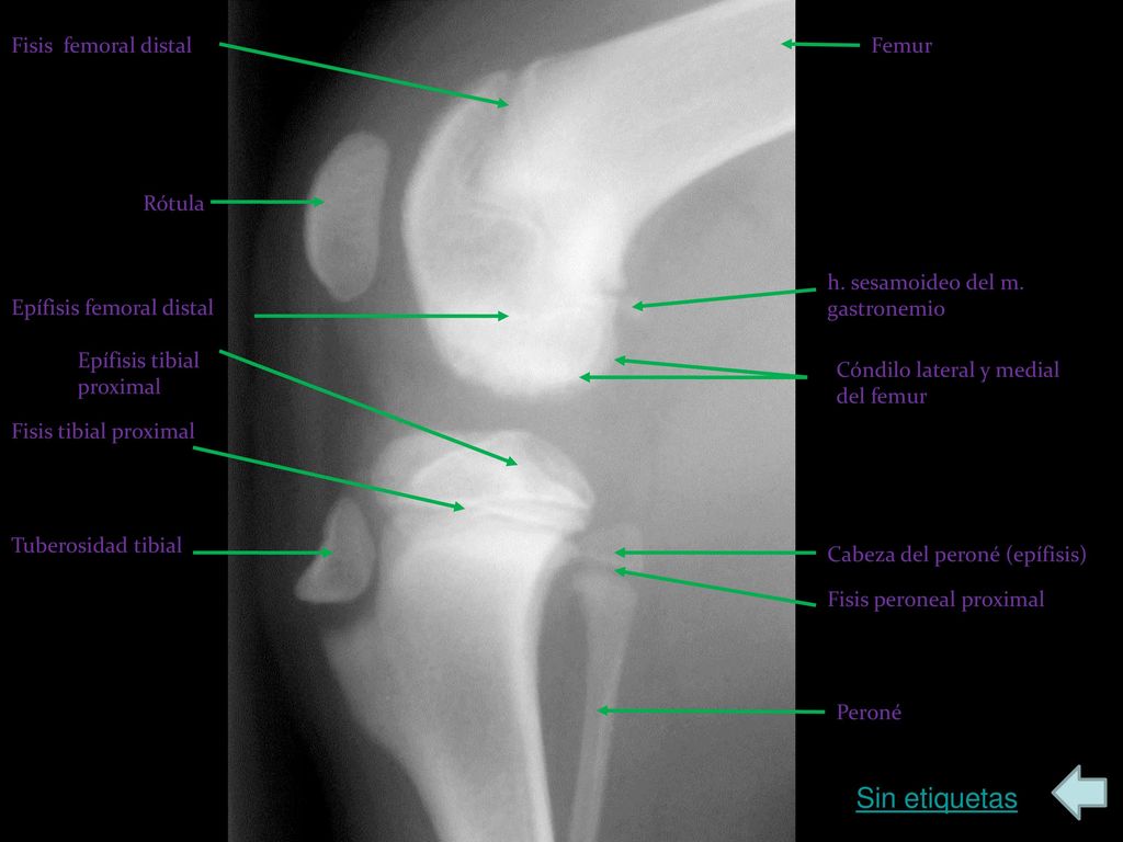 Sin etiquetas Fisis femoral distal Femur Rótula