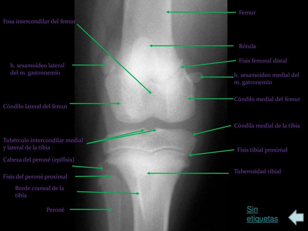 Sin etiquetas Femur Fosa intercondilar del femur Rótula
