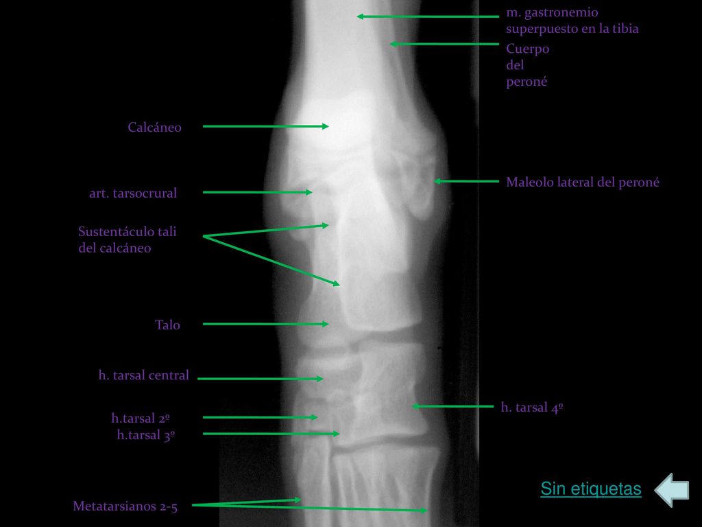 Sin etiquetas m. gastronemio superpuesto en la tibia Cuerpo del peroné