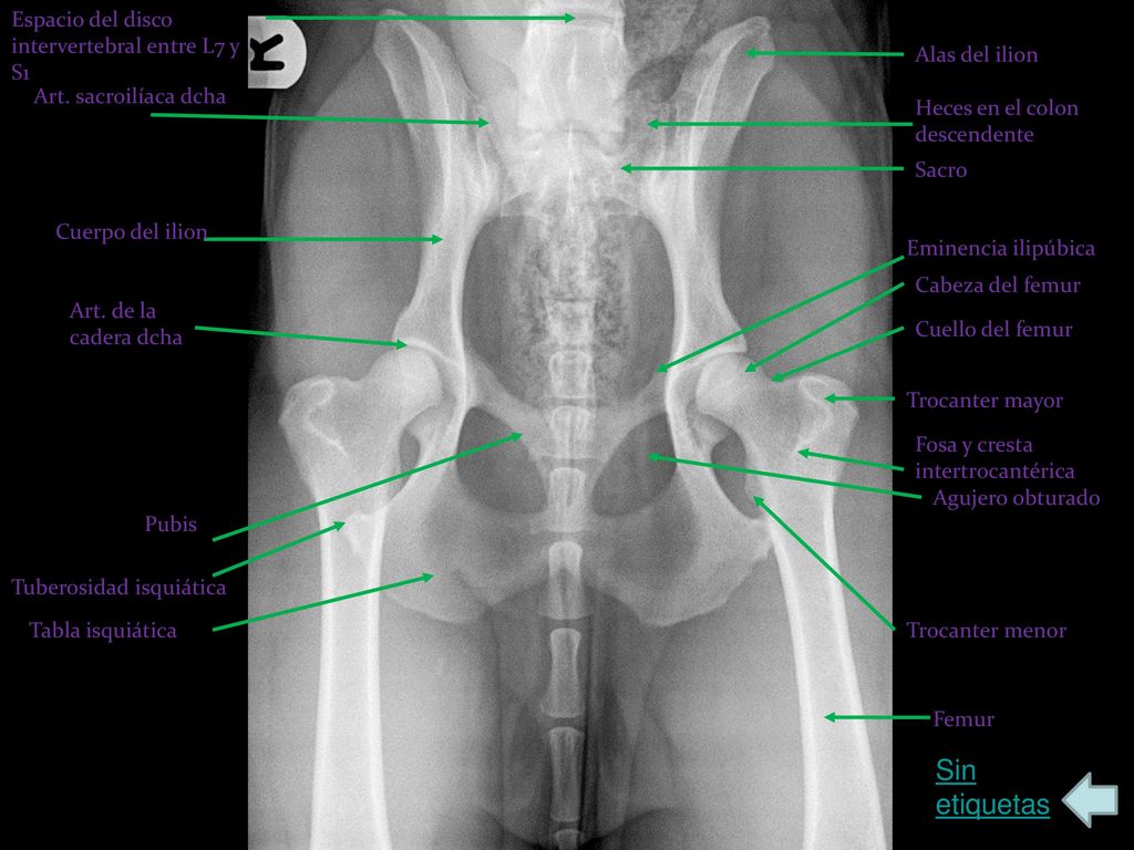 Sin etiquetas Espacio del disco intervertebral entre L7 y S1