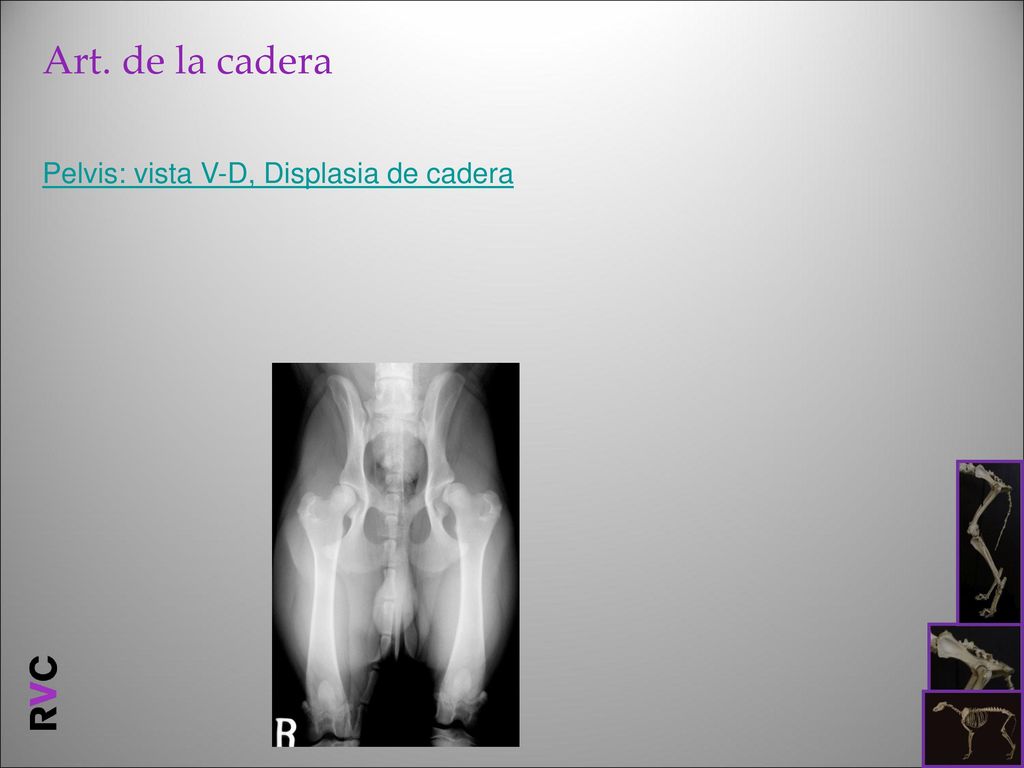 Art. de la cadera Pelvis: vista V-D, Displasia de cadera