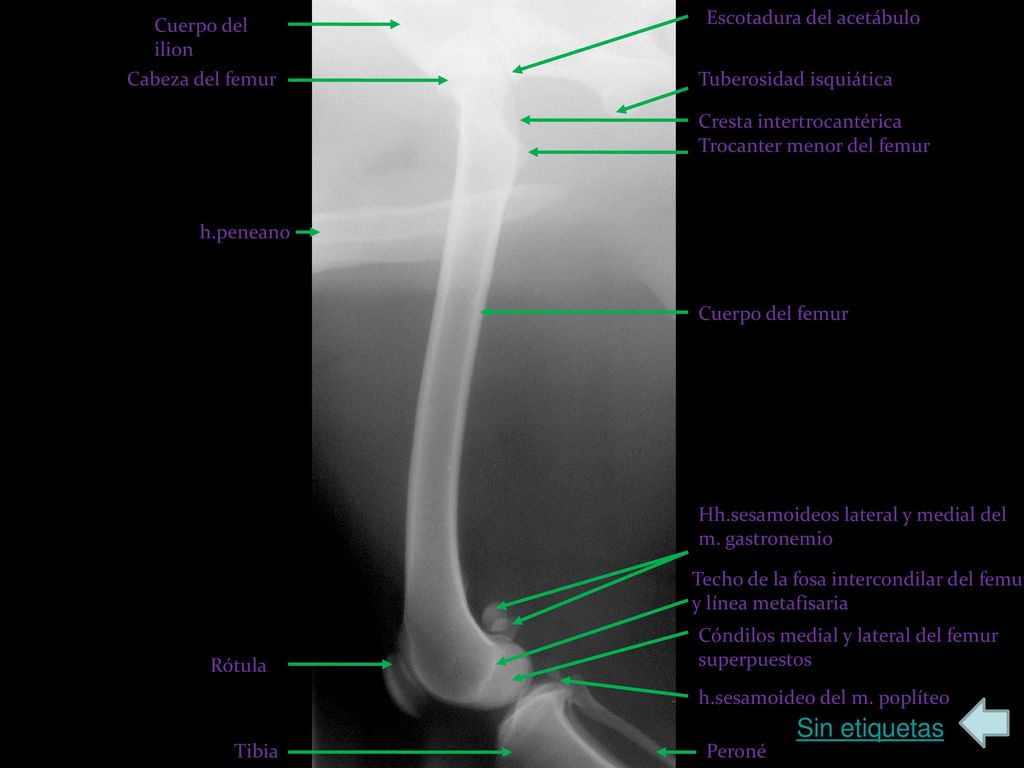 Sin etiquetas Escotadura del acetábulo Cuerpo del ilion