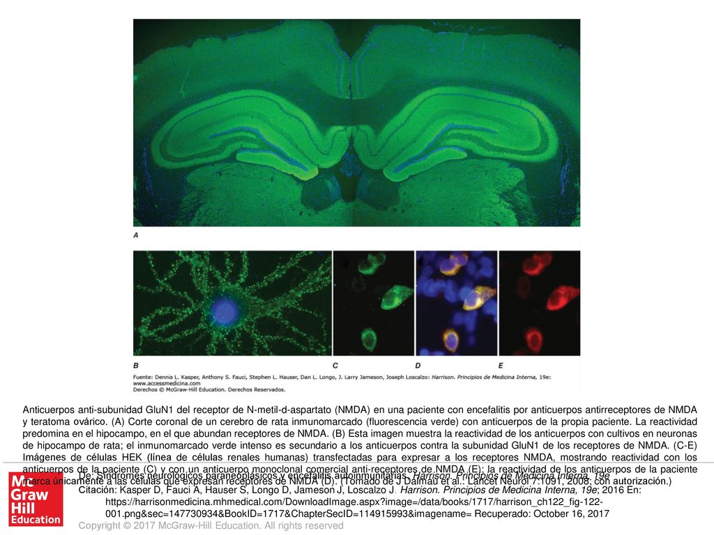Anticuerpos anti-subunidad GluN1 del receptor de N-metil-d-aspartato (NMDA) en una paciente con encefalitis por anticuerpos antirreceptores de NMDA y teratoma ovárico. (A) Corte coronal de un cerebro de rata inmunomarcado (fluorescencia verde) con anticuerpos de la propia paciente. La reactividad predomina en el hipocampo, en el que abundan receptores de NMDA. (B) Esta imagen muestra la reactividad de los anticuerpos con cultivos en neuronas de hipocampo de rata; el inmunomarcado verde intenso es secundario a los anticuerpos contra la subunidad GluN1 de los receptores de NMDA. (C-E) Imágenes de células HEK (línea de células renales humanas) transfectadas para expresar a los receptores NMDA, mostrando reactividad con los anticuerpos de la paciente (C) y con un anticuerpo monoclonal comercial anti-receptores de NMDA (E); la reactividad de los anticuerpos de la paciente marca únicamente a las células que expresan receptores de NMDA (D). (Tomado de J Dalmau et al.: Lancet Neurol 7:1091, 2008; con autorización.)