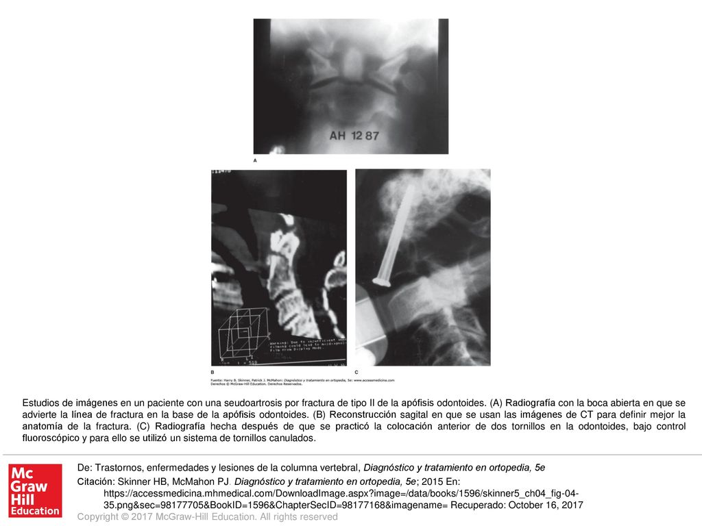 Estudios de imágenes en un paciente con una seudoartrosis por fractura de tipo II de la apófisis odontoides. (A) Radiografía con la boca abierta en que se advierte la línea de fractura en la base de la apófisis odontoides. (B) Reconstrucción sagital en que se usan las imágenes de CT para definir mejor la anatomía de la fractura. (C) Radiografía hecha después de que se practicó la colocación anterior de dos tornillos en la odontoides, bajo control fluoroscópico y para ello se utilizó un sistema de tornillos canulados.