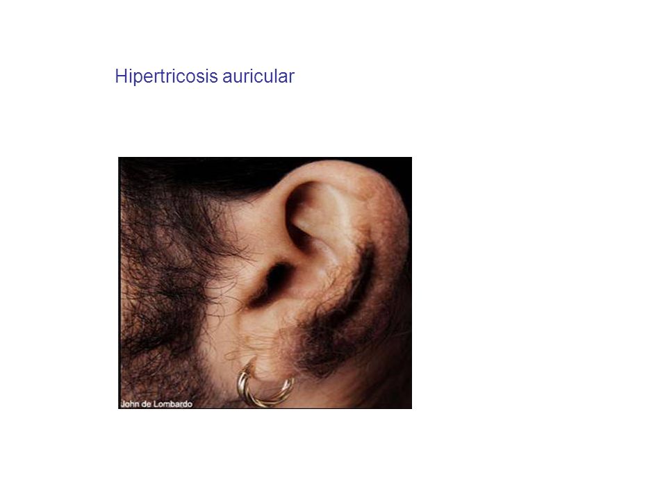 Hipertricosis auricular