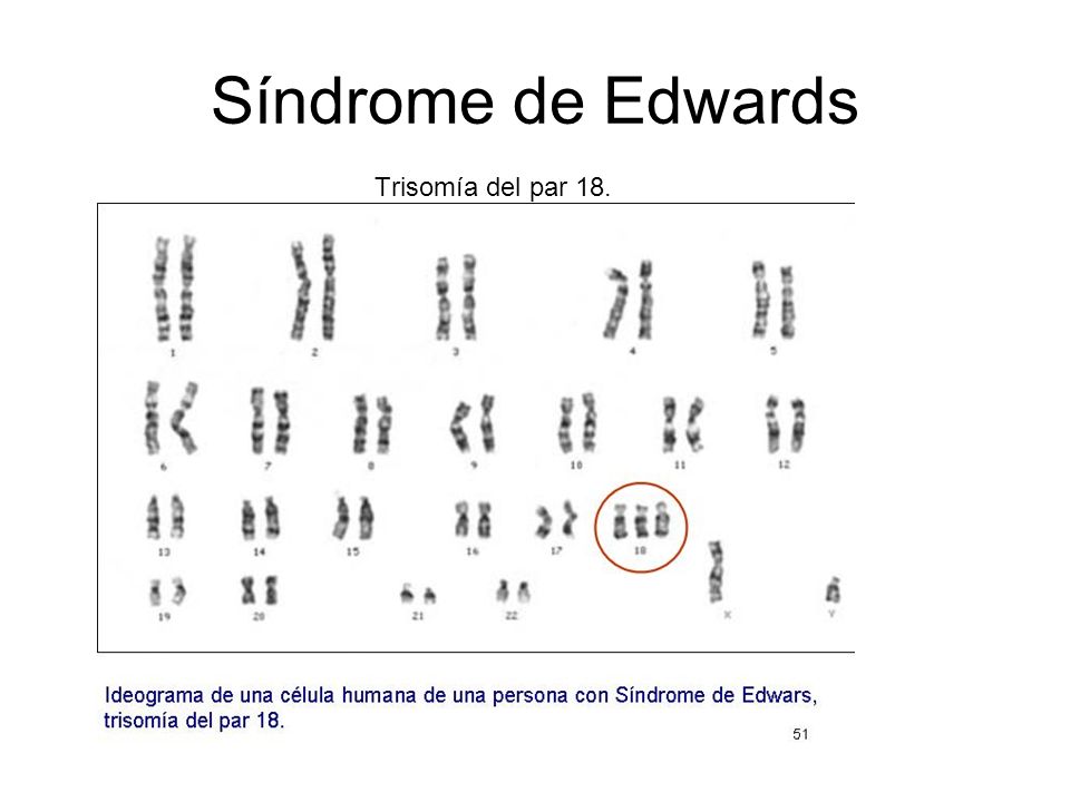 Síndrome de Edwards Trisomía del par 18.