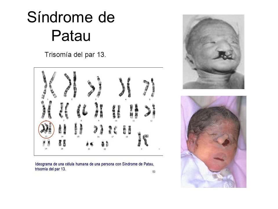 Síndrome de Patau Trisomía del par 13.