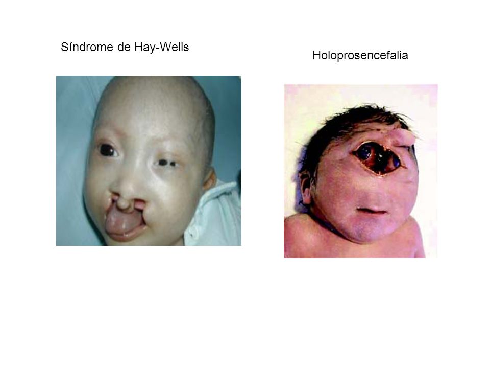 Síndrome de Hay-Wells Holoprosencefalia