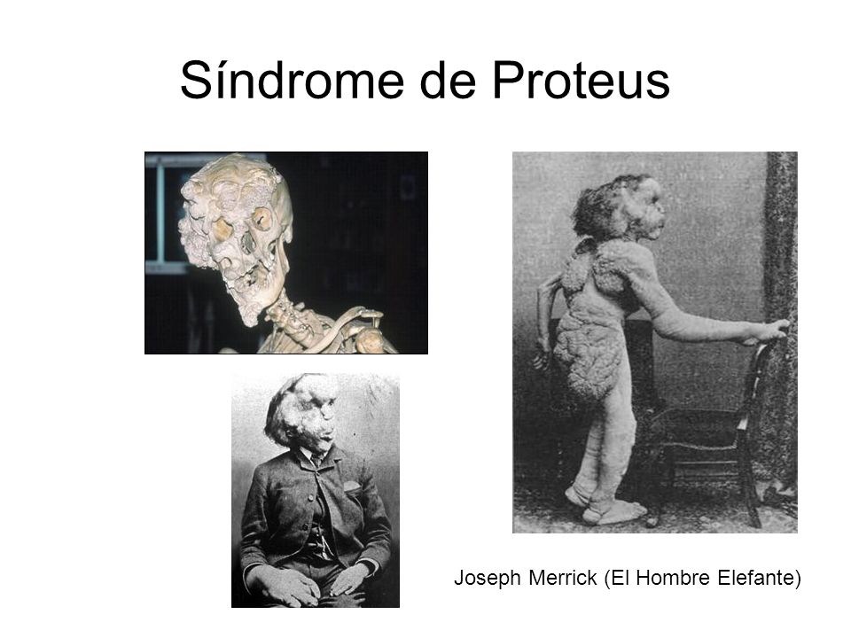 Síndrome de Proteus Joseph Merrick (El Hombre Elefante)