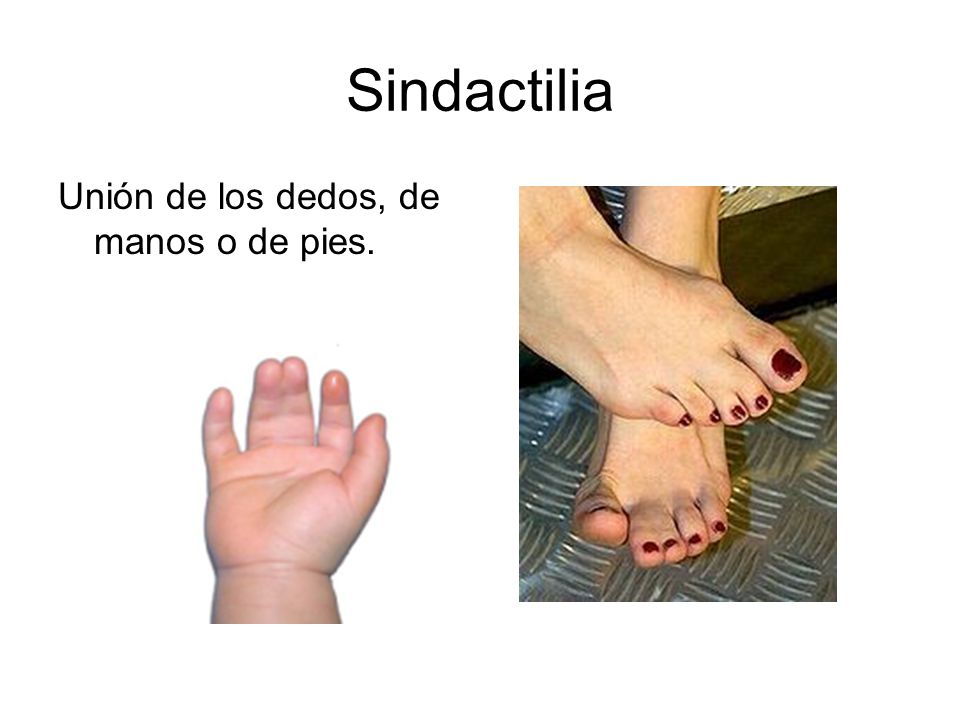 Sindactilia Unión de los dedos, de manos o de pies.
