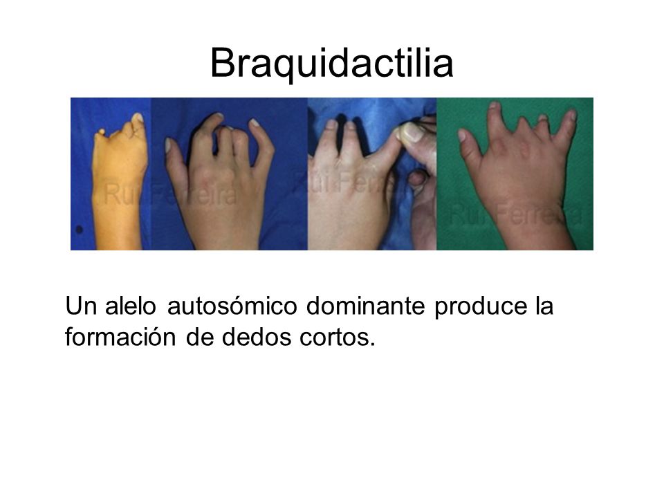 Braquidactilia Un alelo autosómico dominante produce la formación de dedos cortos.