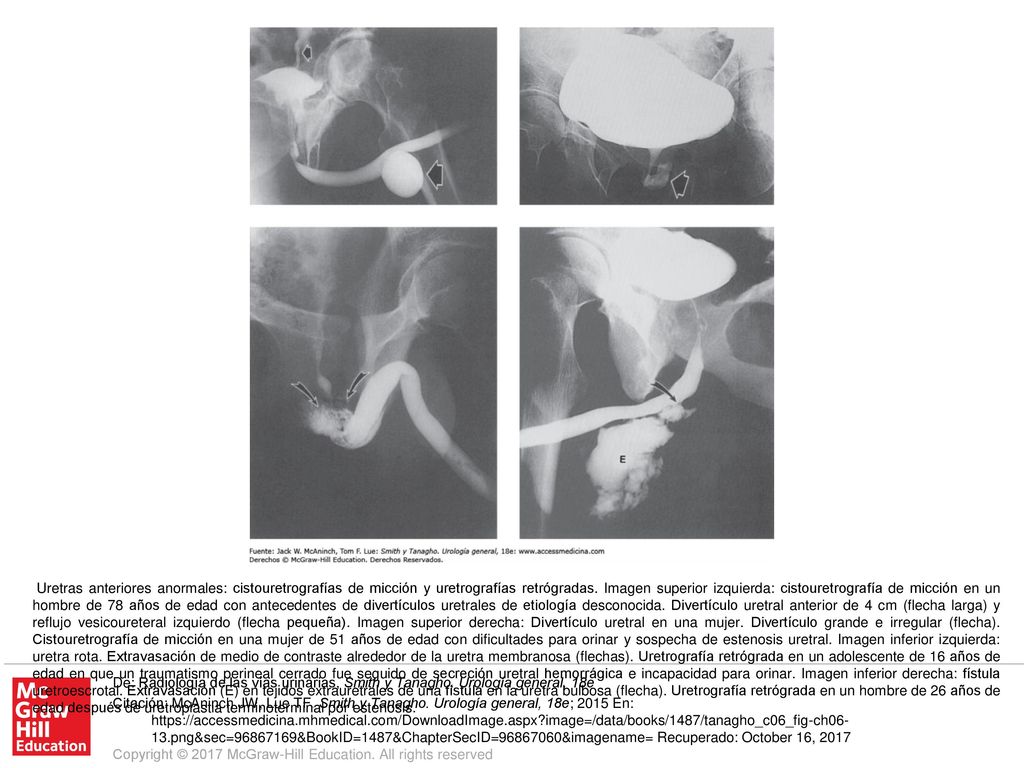 Uretras anteriores anormales: cistouretrografías de micción y uretrografías retrógradas. Imagen superior izquierda: cistouretrografía de micción en un hombre de 78 años de edad con antecedentes de divertículos uretrales de etiología desconocida. Divertículo uretral anterior de 4 cm (flecha larga) y reflujo vesicoureteral izquierdo (flecha pequeña). Imagen superior derecha: Divertículo uretral en una mujer. Divertículo grande e irregular (flecha). Cistouretrografía de micción en una mujer de 51 años de edad con dificultades para orinar y sospecha de estenosis uretral. Imagen inferior izquierda: uretra rota. Extravasación de medio de contraste alrededor de la uretra membranosa (flechas). Uretrografía retrógrada en un adolescente de 16 años de edad en que un traumatismo perineal cerrado fue seguido de secreción uretral hemorrágica e incapacidad para orinar. Imagen inferior derecha: fístula uretroescrotal. Extravasación (E) en tejidos extrauretrales de una fístula en la uretra bulbosa (flecha). Uretrografía retrógrada en un hombre de 26 años de edad después de uretroplastia terminoterminal por estenosis.