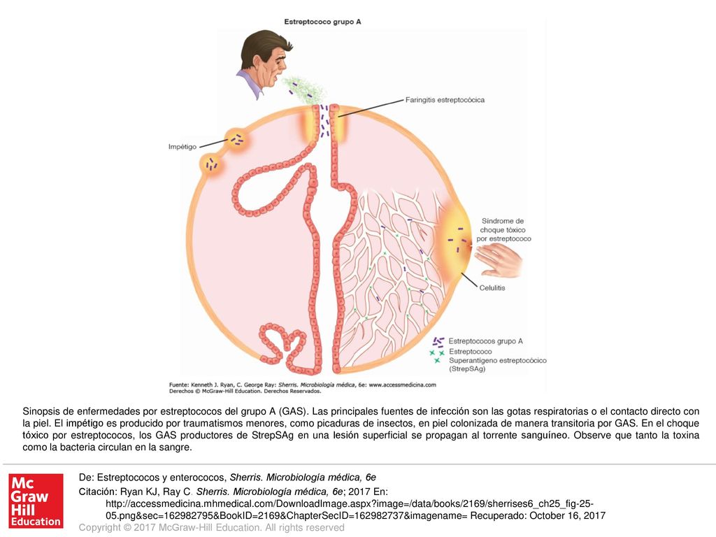 Sinopsis de enfermedades por estreptococos del grupo A (GAS)