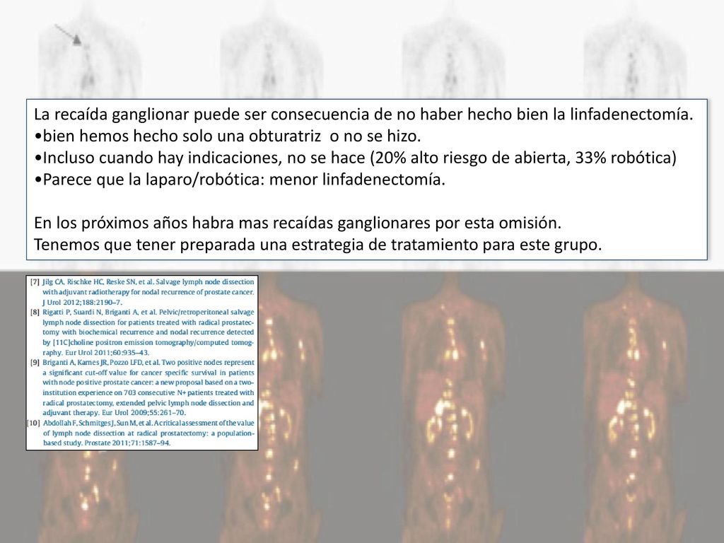 La recaída ganglionar puede ser consecuencia de no haber hecho bien la linfadenectomía.