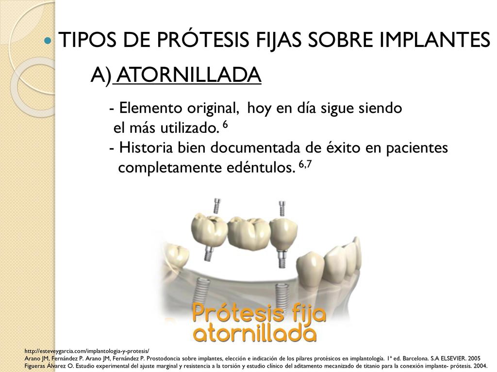 TIPOS DE PRÓTESIS FIJAS SOBRE IMPLANTES