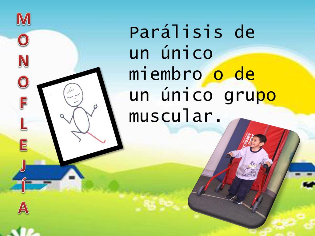 M O N F L E J Í A Parálisis de un único miembro o de un único grupo muscular.