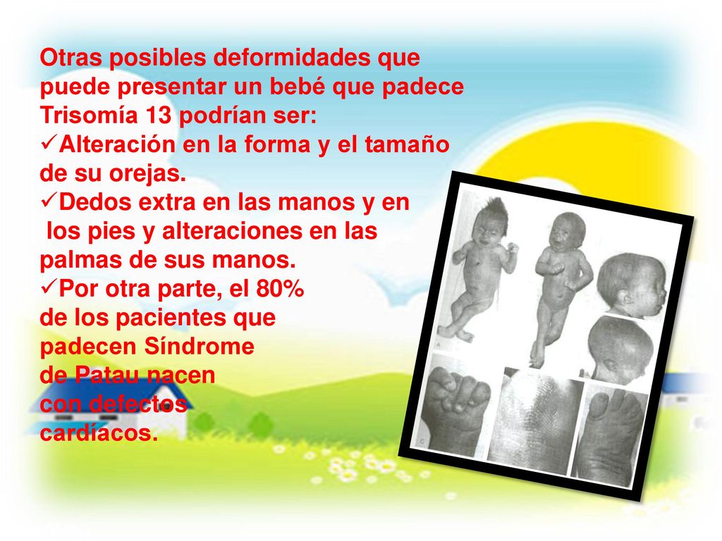 Otras posibles deformidades que puede presentar un bebé que padece Trisomía 13 podrían ser: