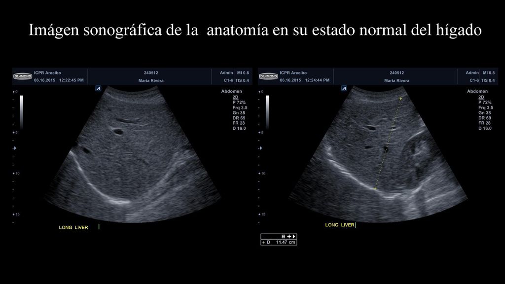 Imágen sonográfica de la anatomía en su estado normal del hígado