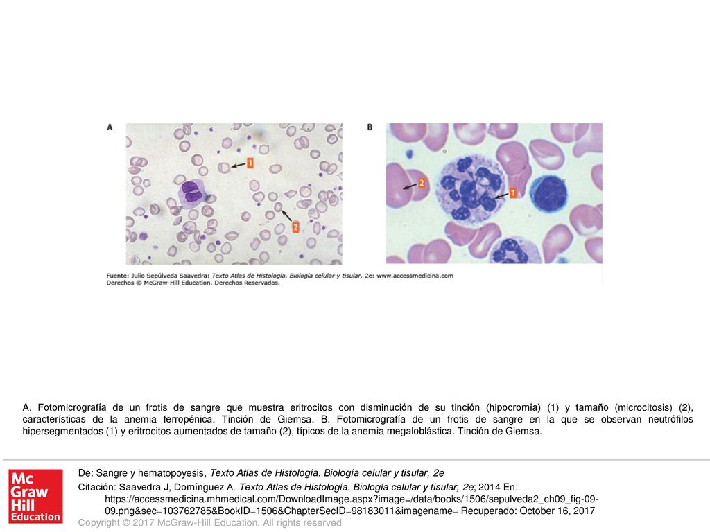 A. Fotomicrografía de un frotis de sangre que muestra eritrocitos con disminución de su tinción (hipocromía) (1) y tamaño (microcitosis) (2), características de la anemia ferropénica. Tinción de Giemsa. B. Fotomicrografía de un frotis de sangre en la que se observan neutrófilos hipersegmentados (1) y eritrocitos aumentados de tamaño (2), típicos de la anemia megaloblástica. Tinción de Giemsa.