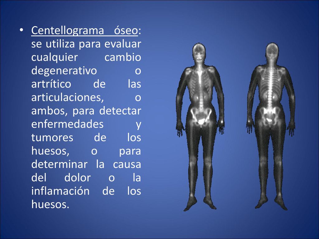 Centellograma óseo: se utiliza para evaluar cualquier cambio degenerativo o artrítico de las articulaciones, o ambos, para detectar enfermedades y tumores de los huesos, o para determinar la causa del dolor o la inflamación de los huesos.