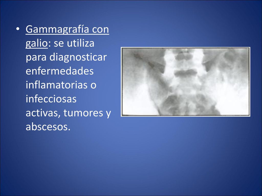 Gammagrafía con galio: se utiliza para diagnosticar enfermedades inflamatorias o infecciosas activas, tumores y abscesos.