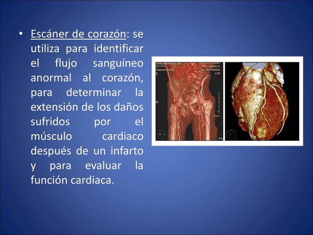 Escáner de corazón: se utiliza para identificar el flujo sanguíneo anormal al corazón, para determinar la extensión de los daños sufridos por el músculo cardiaco después de un infarto y para evaluar la función cardiaca.