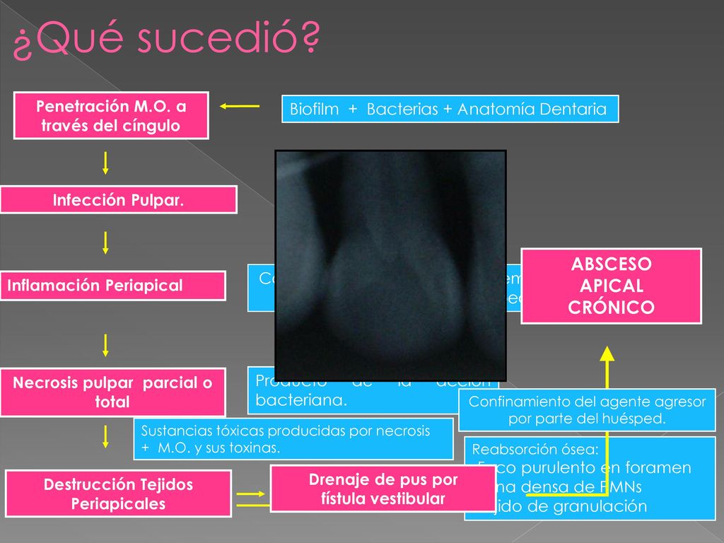 Penetración M.O. a través del cíngulo Necrosis pulpar parcial o total