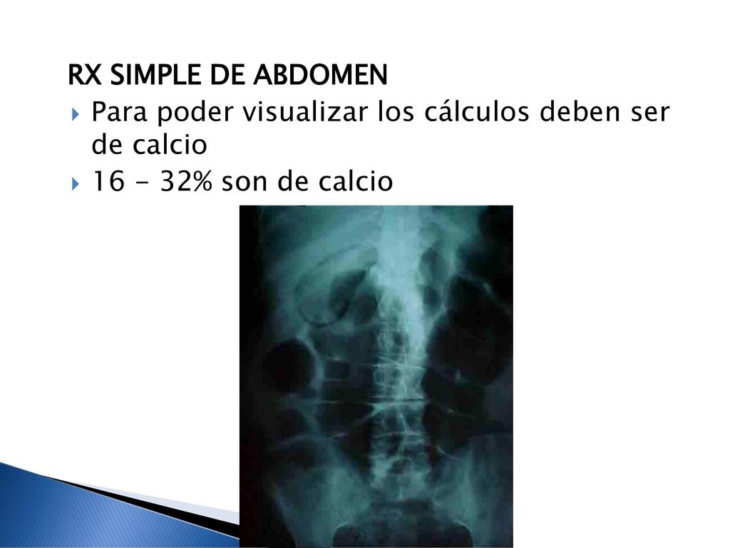 RX SIMPLE DE ABDOMEN Para poder visualizar los cálculos deben ser de calcio % son de calcio