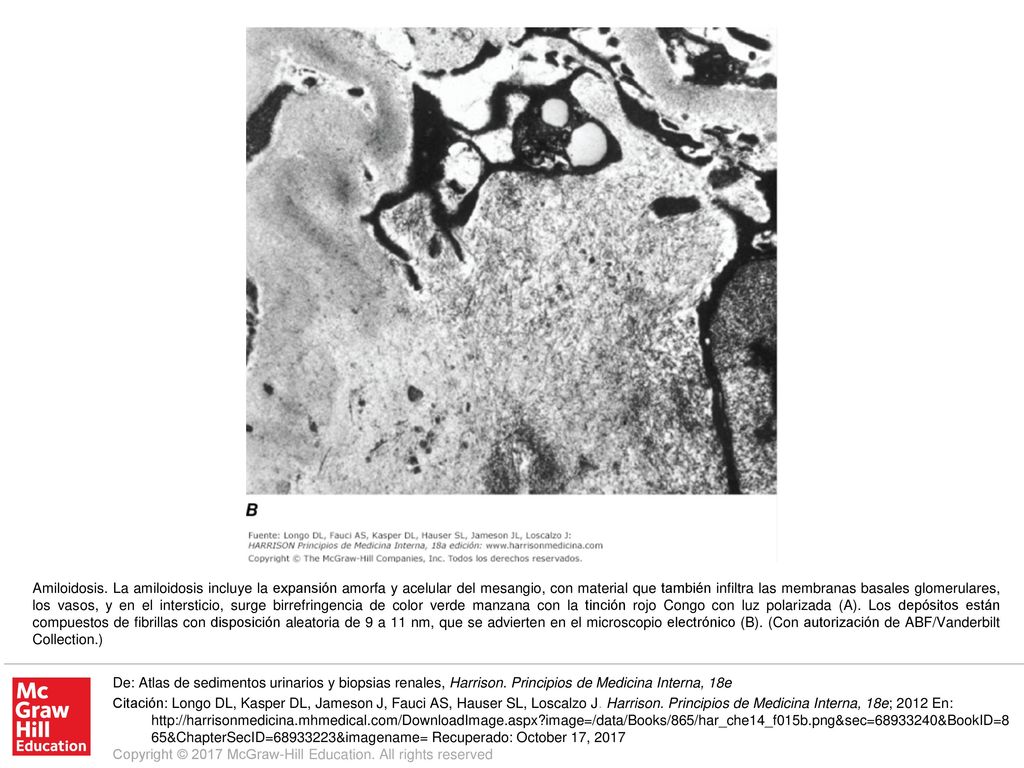 Amiloidosis. La amiloidosis incluye la expansión amorfa y acelular del mesangio, con material que también infiltra las membranas basales glomerulares, los vasos, y en el intersticio, surge birrefringencia de color verde manzana con la tinción rojo Congo con luz polarizada (A). Los depósitos están compuestos de fibrillas con disposición aleatoria de 9 a 11 nm, que se advierten en el microscopio electrónico (B). (Con autorización de ABF/Vanderbilt Collection.)