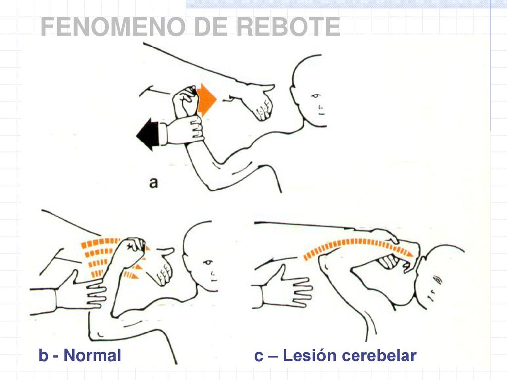 FENOMENO DE REBOTE b - Normal c – Lesión cerebelar