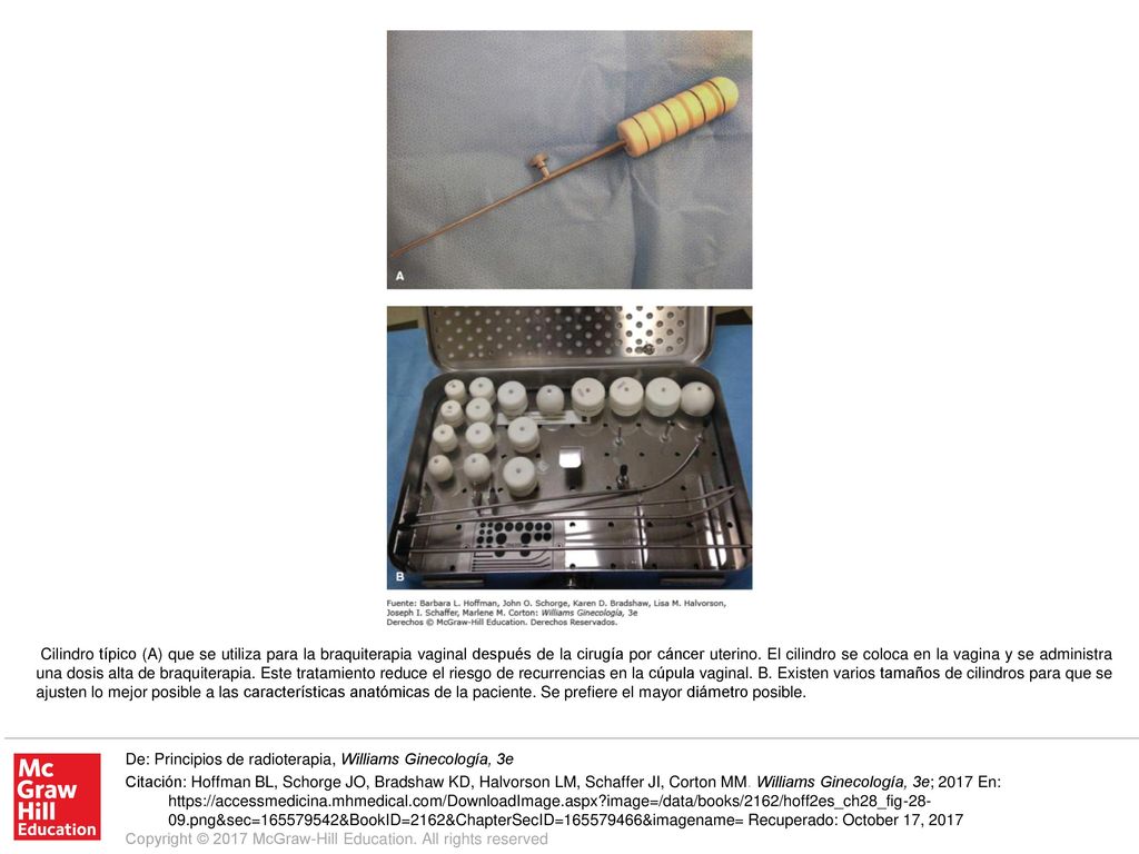 Cilindro típico (A) que se utiliza para la braquiterapia vaginal después de la cirugía por cáncer uterino. El cilindro se coloca en la vagina y se administra una dosis alta de braquiterapia. Este tratamiento reduce el riesgo de recurrencias en la cúpula vaginal. B. Existen varios tamaños de cilindros para que se ajusten lo mejor posible a las características anatómicas de la paciente. Se prefiere el mayor diámetro posible.