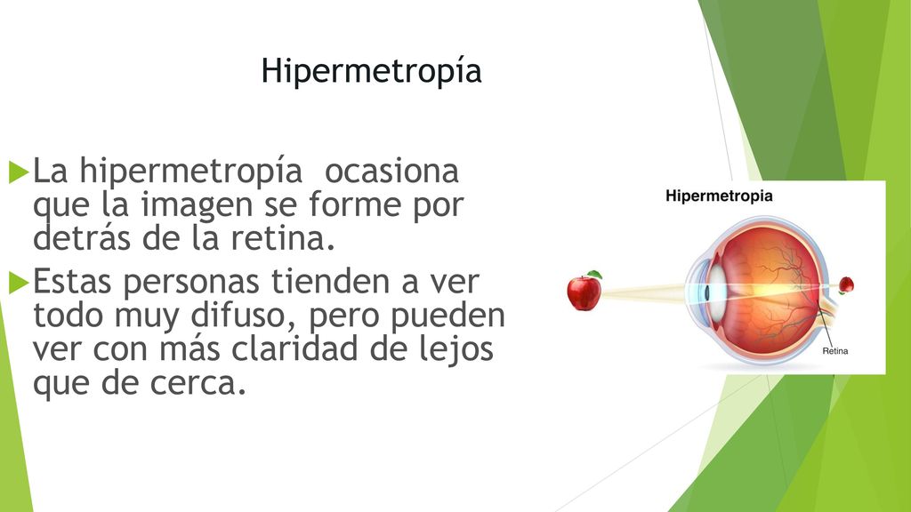 Hipermetropía La hipermetropía ocasiona que la imagen se forme por detrás de la retina.