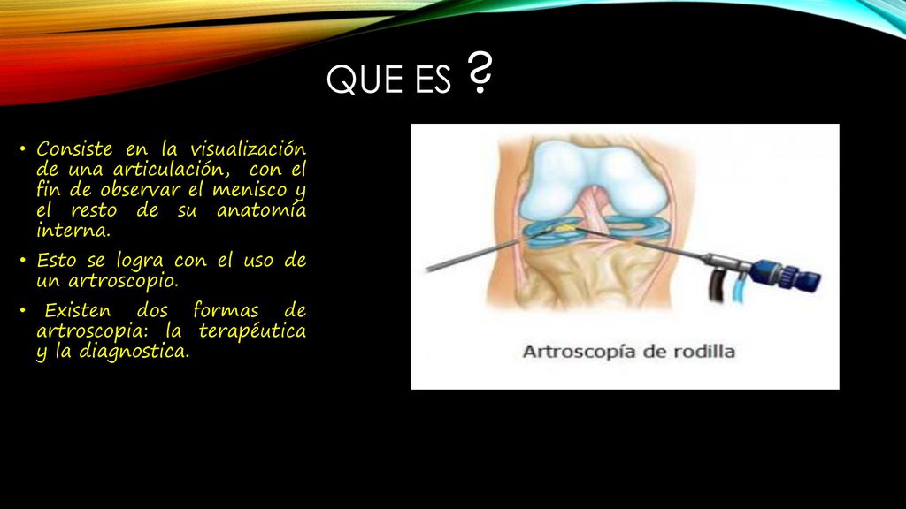 Que es Consiste en la visualización de una articulación, con el fin de observar el menisco y el resto de su anatomía interna.