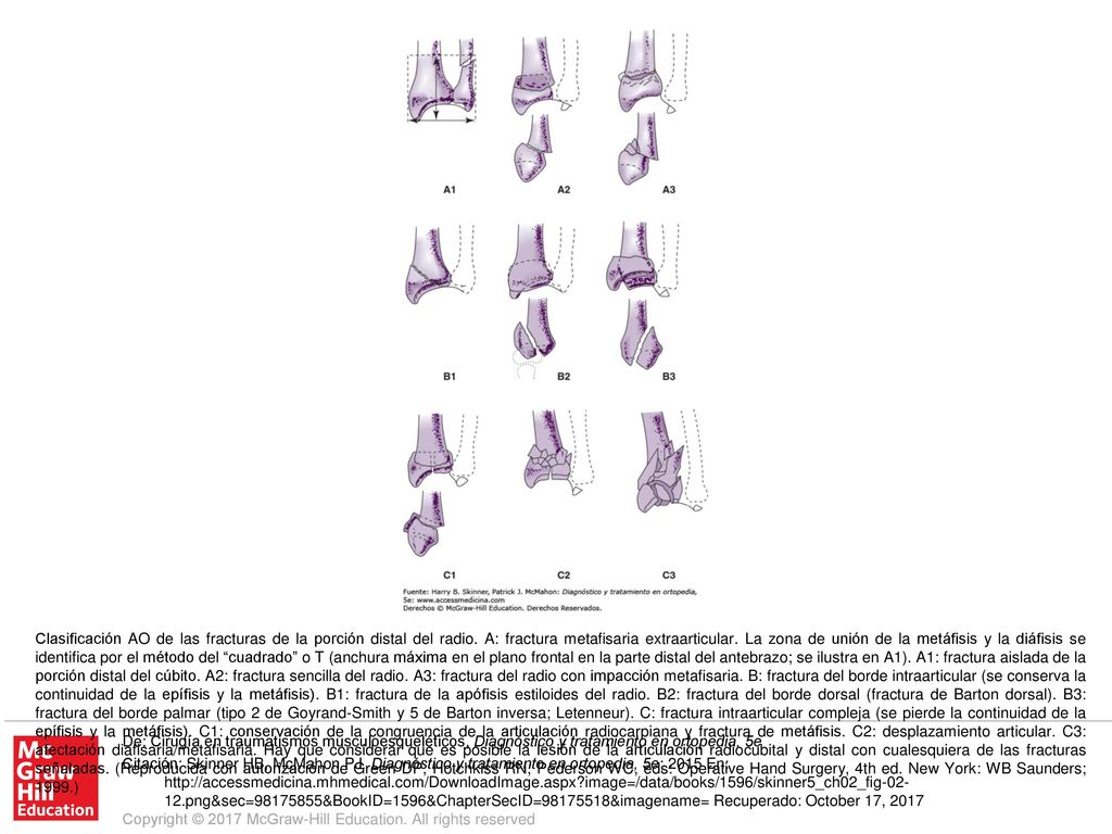 Clasificación AO de las fracturas de la porción distal del radio