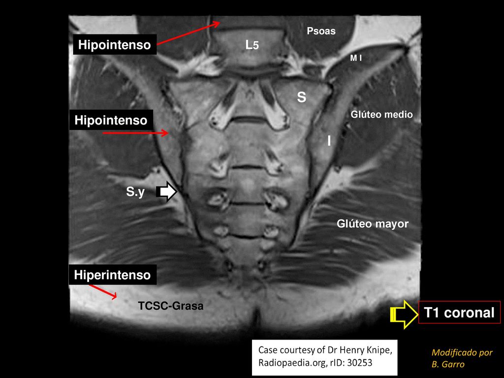 S I T1 coronal Hipointenso L5 Hipointenso S.y Hiperintenso