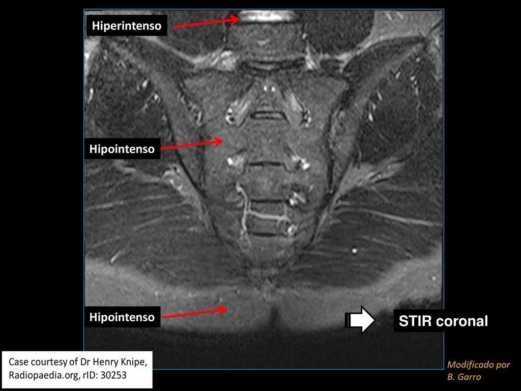 Hiperintenso Hipointenso Coronal STIR Hipointenso STIR coronal