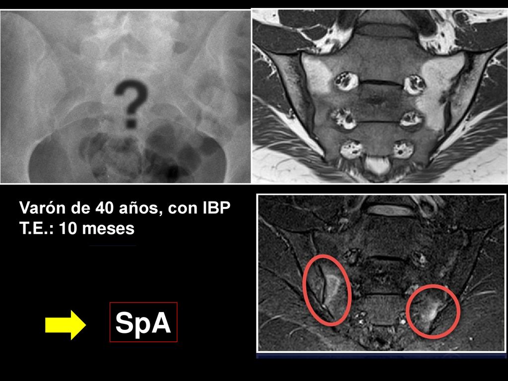 Varón de 40 años, con IBP T.E.: 10 meses SpA