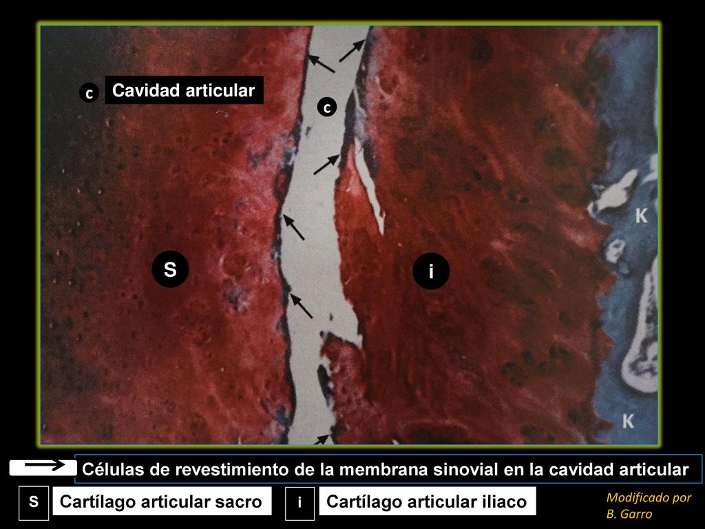 Cavidad articular c. S. i. Histología de la articulación sacroiliaca normal. K: hueso compacto subcondral.