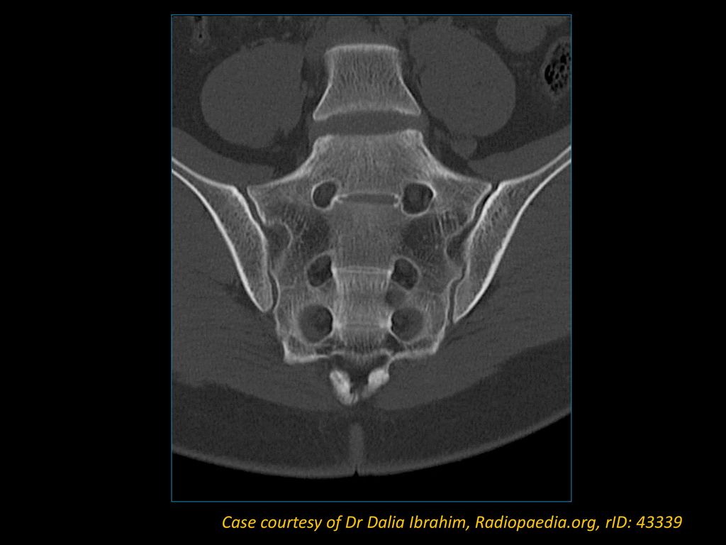 Case courtesy of Dr Dalia Ibrahim, Radiopaedia.org, rID: 43339