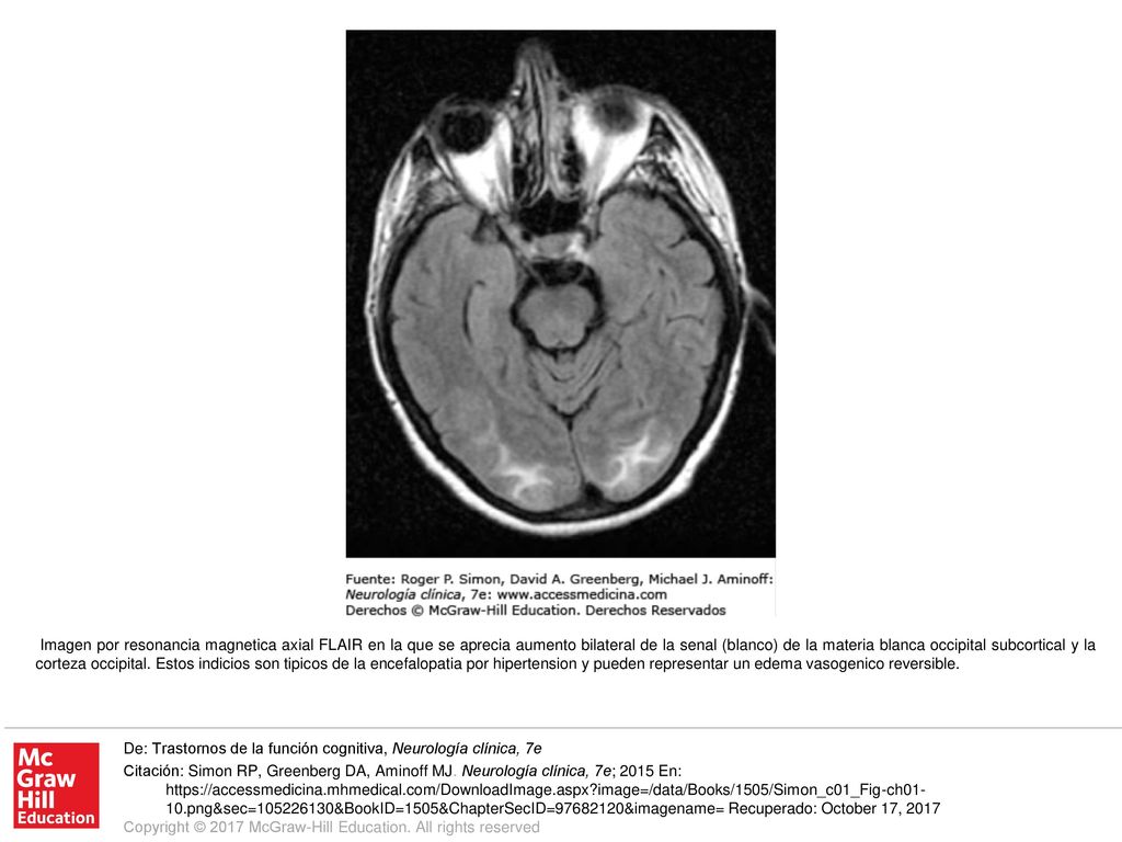 Imagen por resonancia magnetica axial FLAIR en la que se aprecia aumento bilateral de la senal (blanco) de la materia blanca occipital subcortical y la corteza occipital. Estos indicios son tipicos de la encefalopatia por hipertension y pueden representar un edema vasogenico reversible.