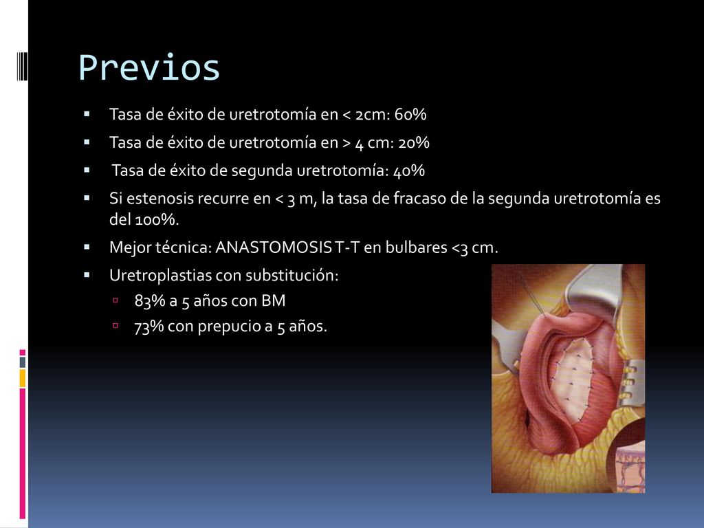 Previos Tasa de éxito de uretrotomía en < 2cm: 60%