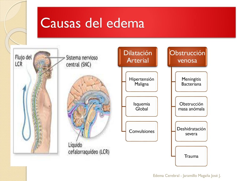 Causas del edema Edema Cerebral - Jaramillo Magaña José J.