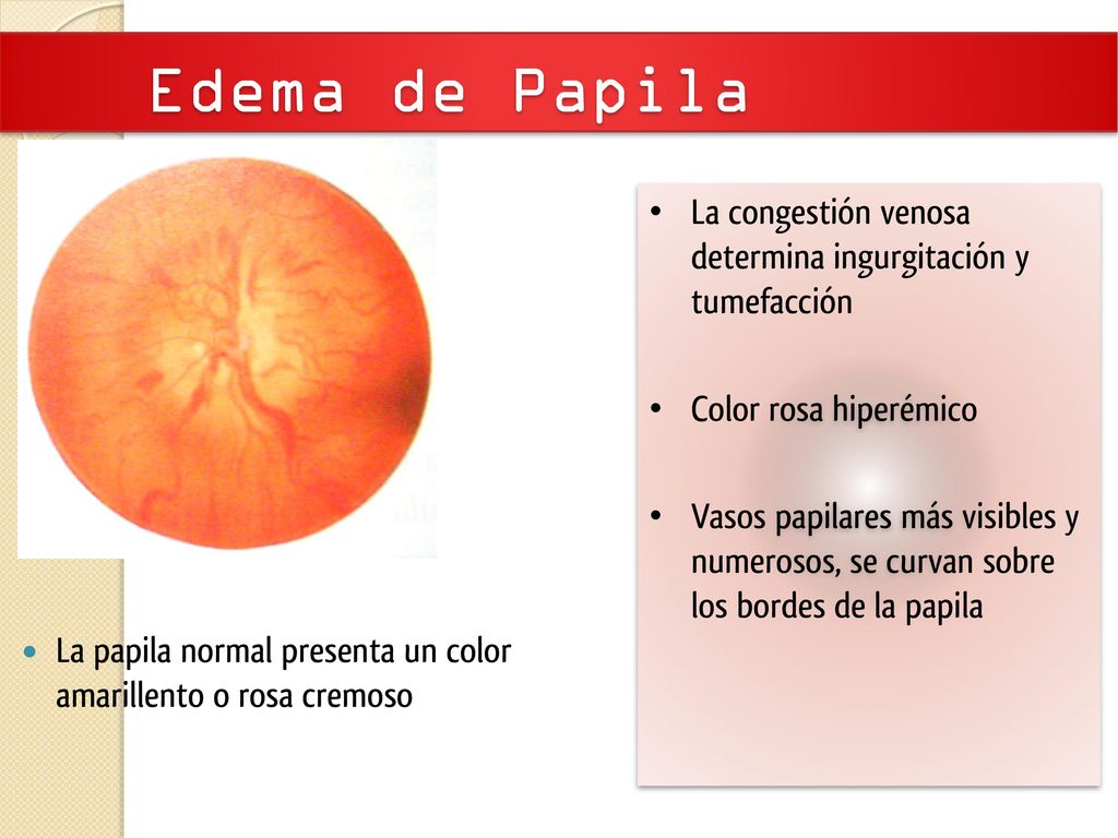 Edema de Papila La congestión venosa determina ingurgitación y tumefacción. Color rosa hiperémico.