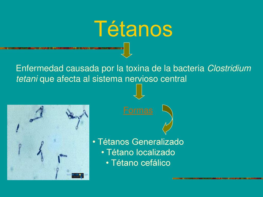 Tétanos Enfermedad causada por la toxina de la bacteria Clostridium tetani que afecta al sistema nervioso central.