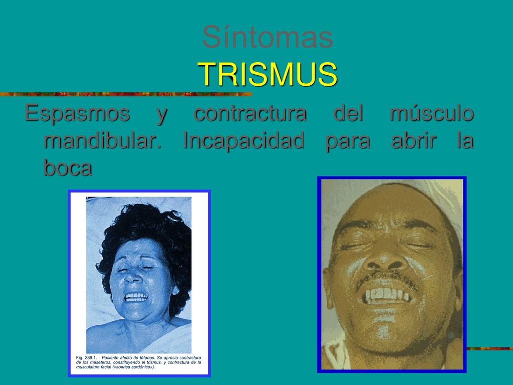 Síntomas TRISMUS Espasmos y contractura del músculo mandibular. Incapacidad para abrir la boca