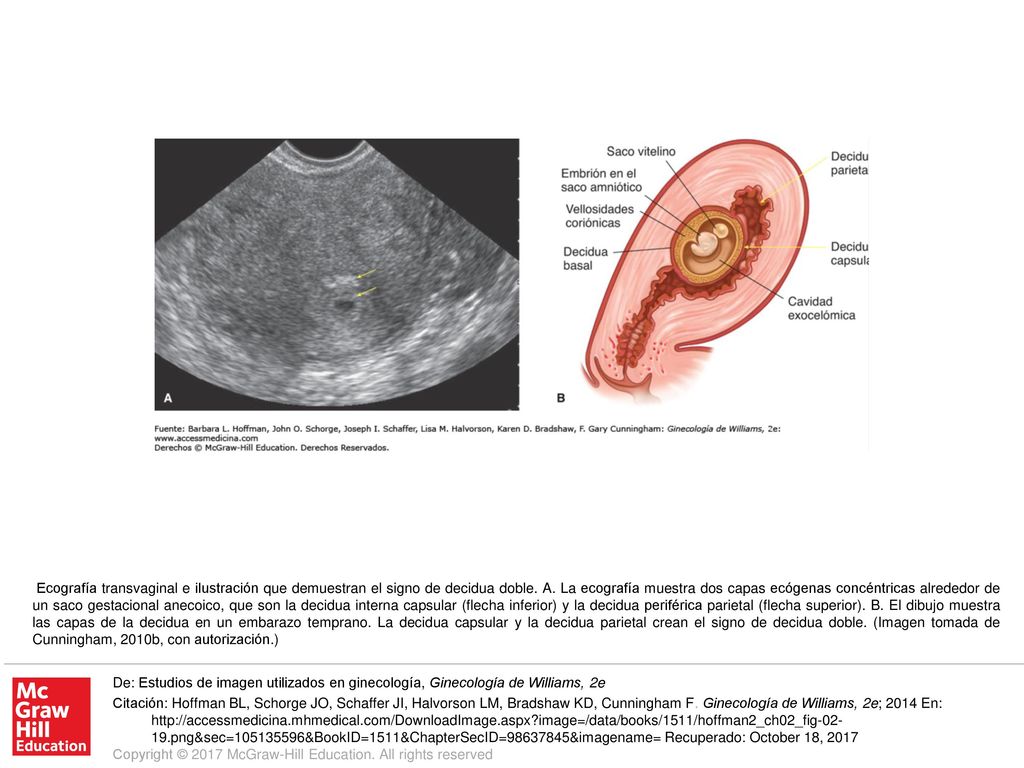 Ecografía transvaginal e ilustración que demuestran el signo de decidua doble. A. La ecografía muestra dos capas ecógenas concéntricas alrededor de un saco gestacional anecoico, que son la decidua interna capsular (flecha inferior) y la decidua periférica parietal (flecha superior). B. El dibujo muestra las capas de la decidua en un embarazo temprano. La decidua capsular y la decidua parietal crean el signo de decidua doble. (Imagen tomada de Cunningham, 2010b, con autorización.)