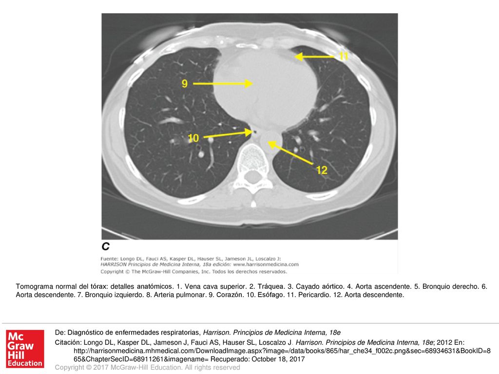 Tomograma normal del tórax: detalles anatómicos. 1. Vena cava superior