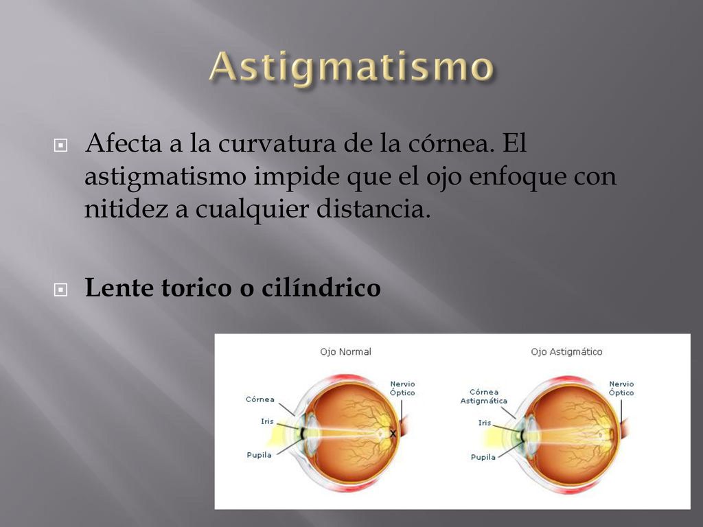 Astigmatismo Afecta a la curvatura de la córnea. El astigmatismo impide que el ojo enfoque con nitidez a cualquier distancia.