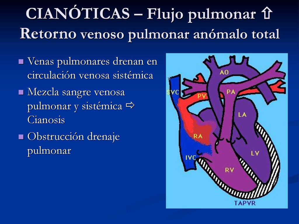 CIANÓTICAS – Flujo pulmonar  Retorno venoso pulmonar anómalo total